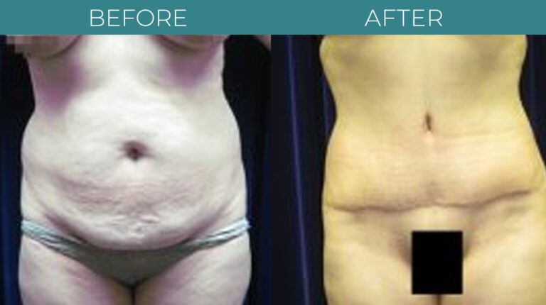 Tummy Tuck-BA_12