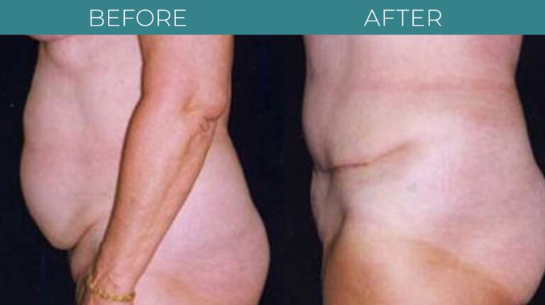 Tummy Tuck-BA_13