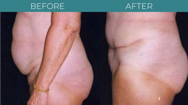 Tummy Tuck-BA_14