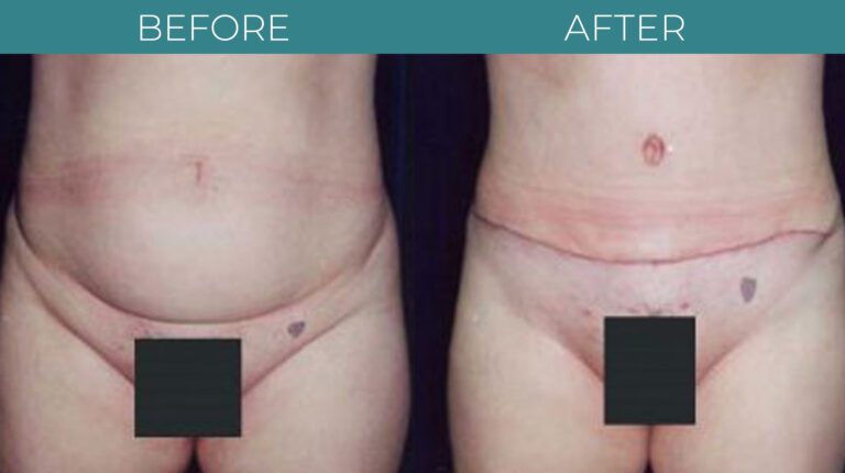 Tummy Tuck-BA_15