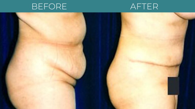 Tummy Tuck-BA_16