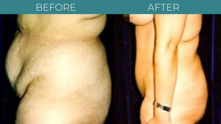 Tummy Tuck-BA_17