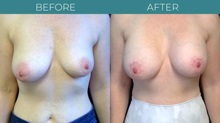 Breast Augmentation-BA_11
