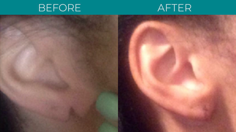 Ear-2