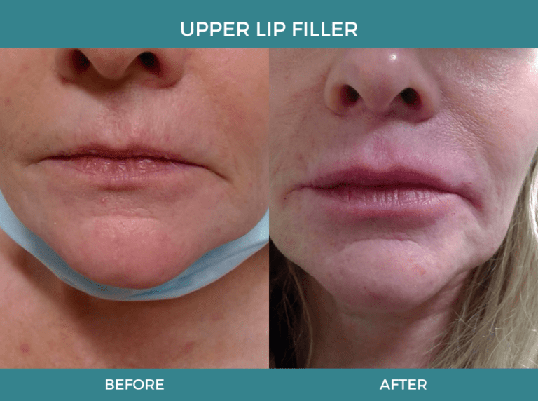 LIP FILLER