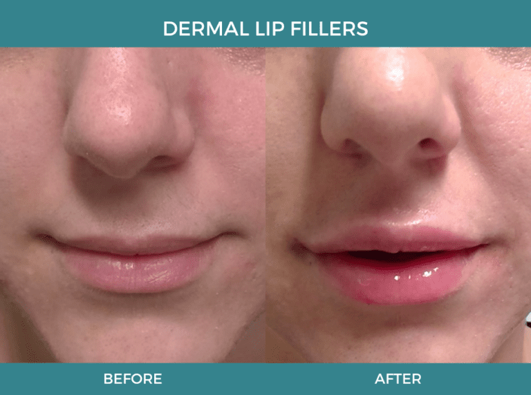 Dermal Lip Fillers