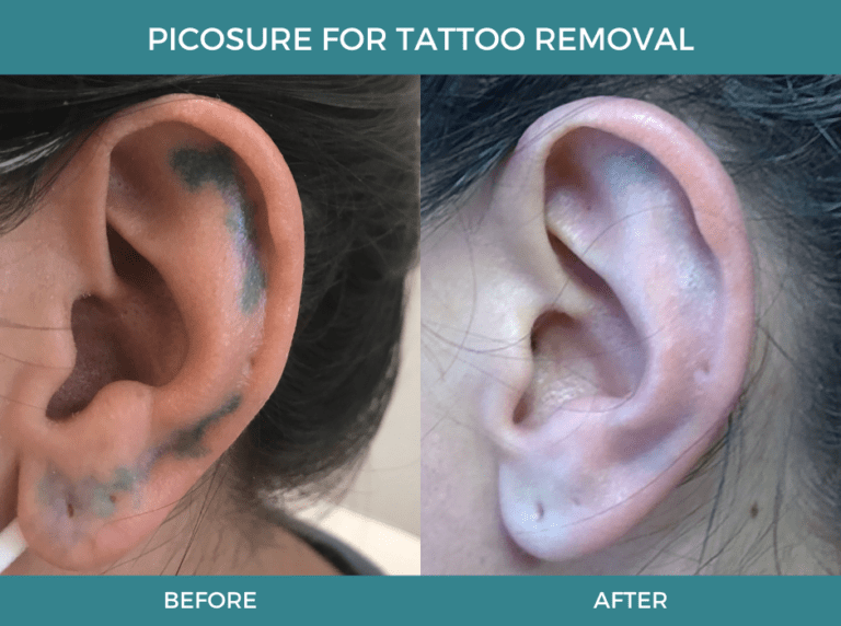 PicoSure