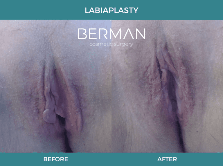 labiaplasty